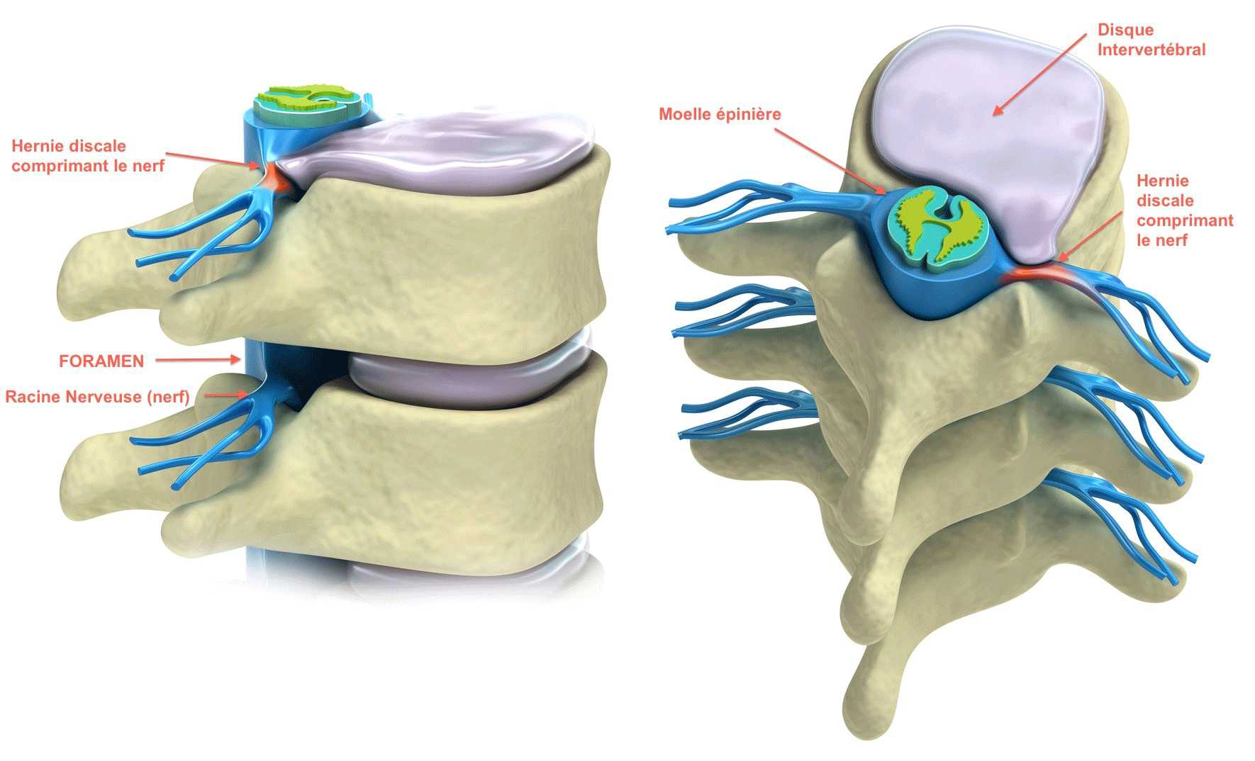Une ceinture lombaire pour soulager votre hernie discale - Mon conseil  orthopédie