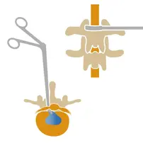 chirurgie-hernie-discale-arthrodese