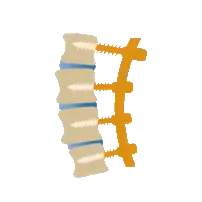 chirurgie-hernie-discale-arthrodese