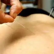 Acupuncture contre le mal de dos