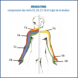 névralgie cervico-brachiale