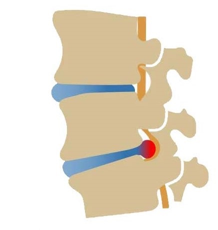 Une ceinture lombaire pour soulager votre hernie discale - Mon conseil  orthopédie