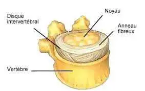 Pincement-discal